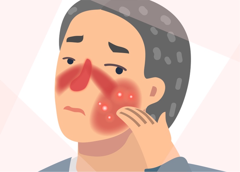 Rosacea description